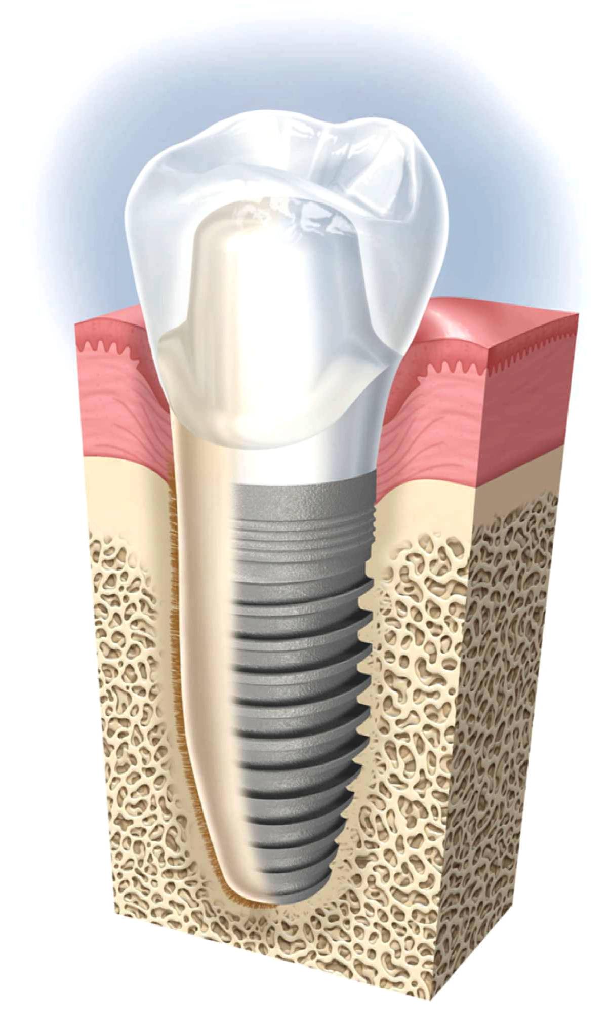 Dental Implant 2